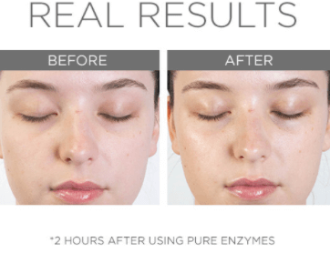 ﻿Chemical Exfoliants 101 with Pure Enzymes - C O S M E D I X